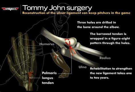 Is Tommy John Surgery Career Ending